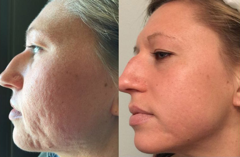 Ideal Candidates for RF Microneedling