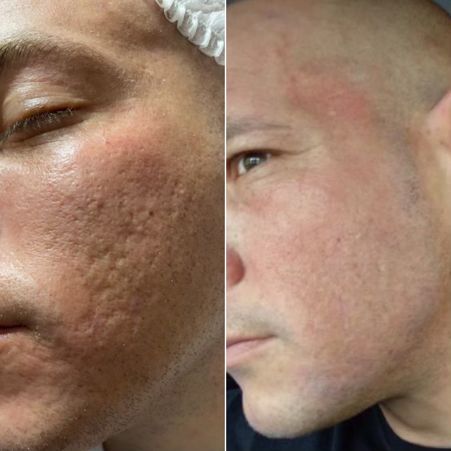 RF Microneedling Vs. Traditional Microneedling