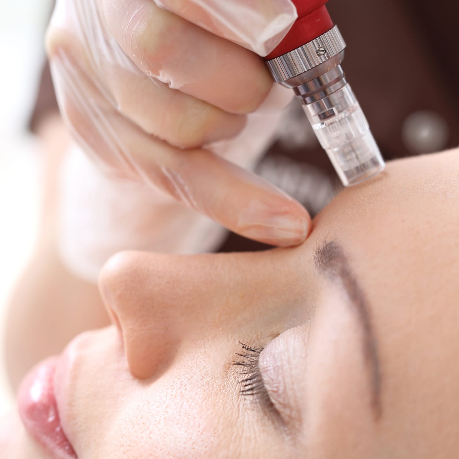 Microneedling for Dark Spot Reduction