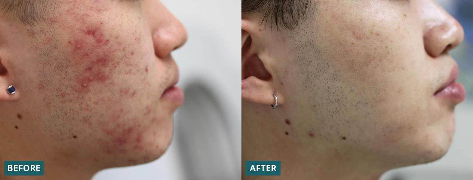 How Microneedling Works