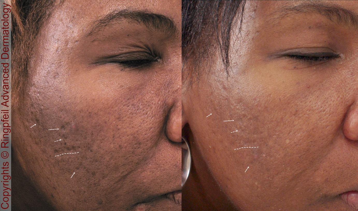 Targeted Chemical Peels