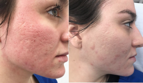 Microneedling Techniques