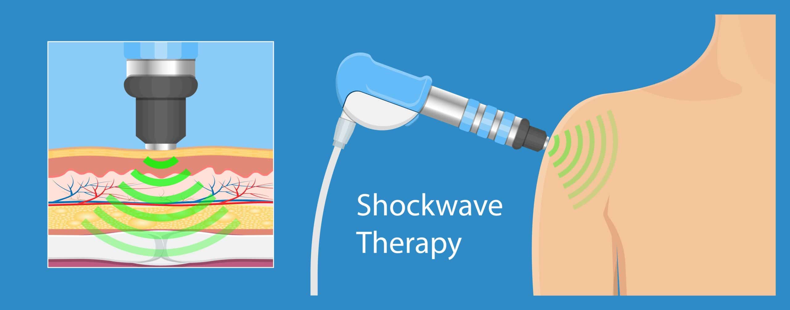 The Facts About Shockwave Therapy Revealed