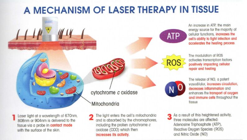 The Best Guide To Shockwave Laser