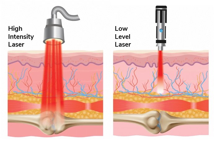 Shockwave Laser Fundamentals Explained