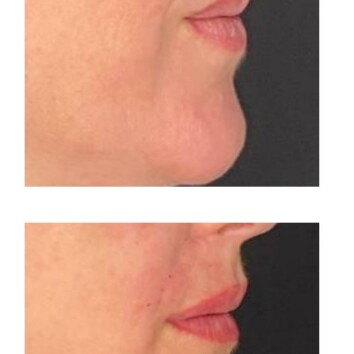 Preenchimento Labial 