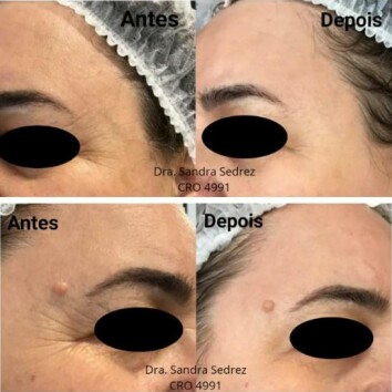 Microagulhamento  Microagulhamento