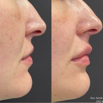 Preenchimento labial  Preenchimento labial