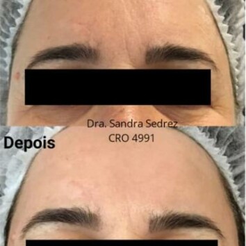 Microagulhamento  Microagulhamento