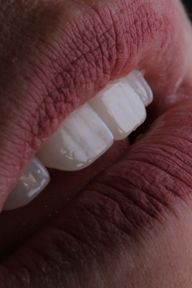 Facetas estéticas 