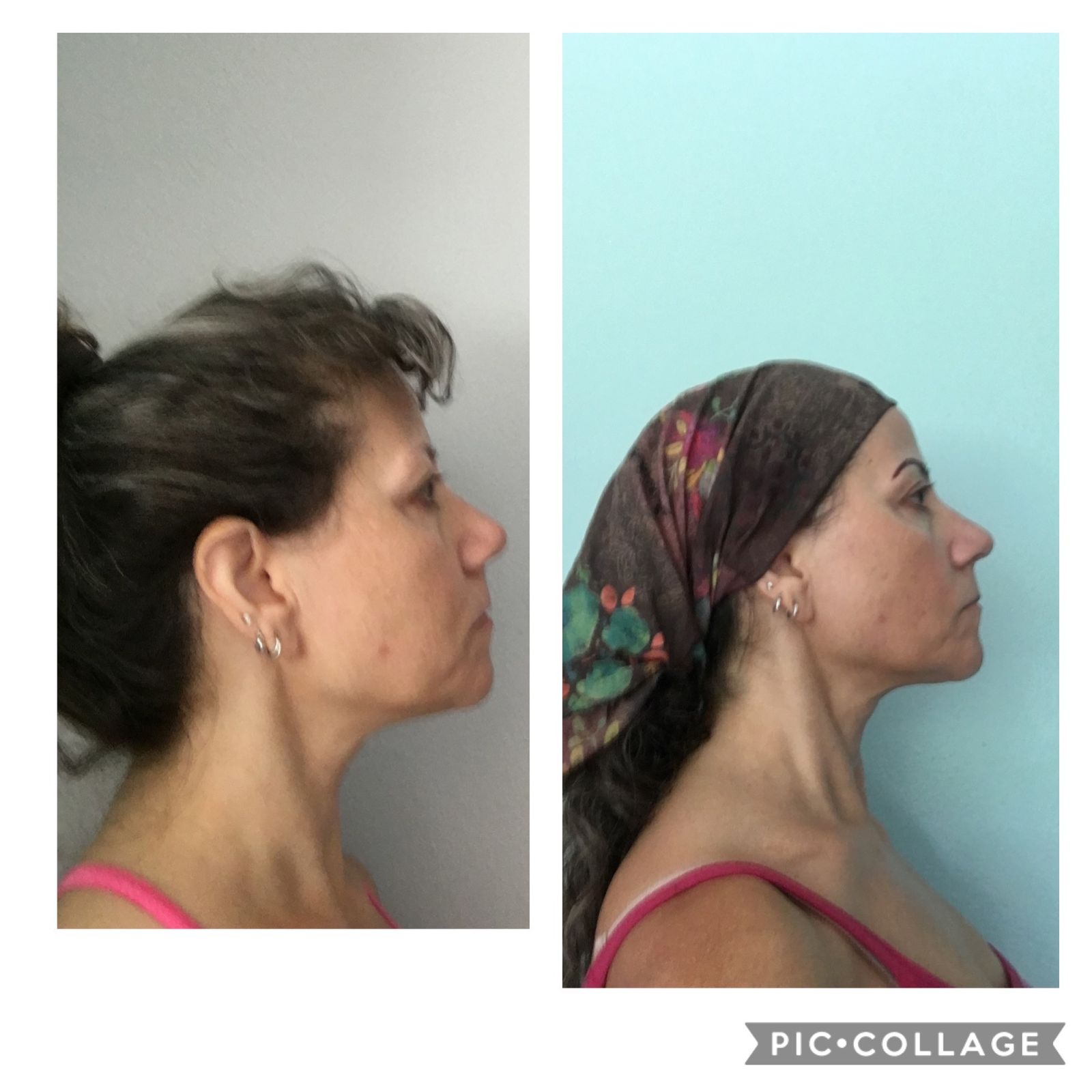 before and after results from face yoga, botox alternative