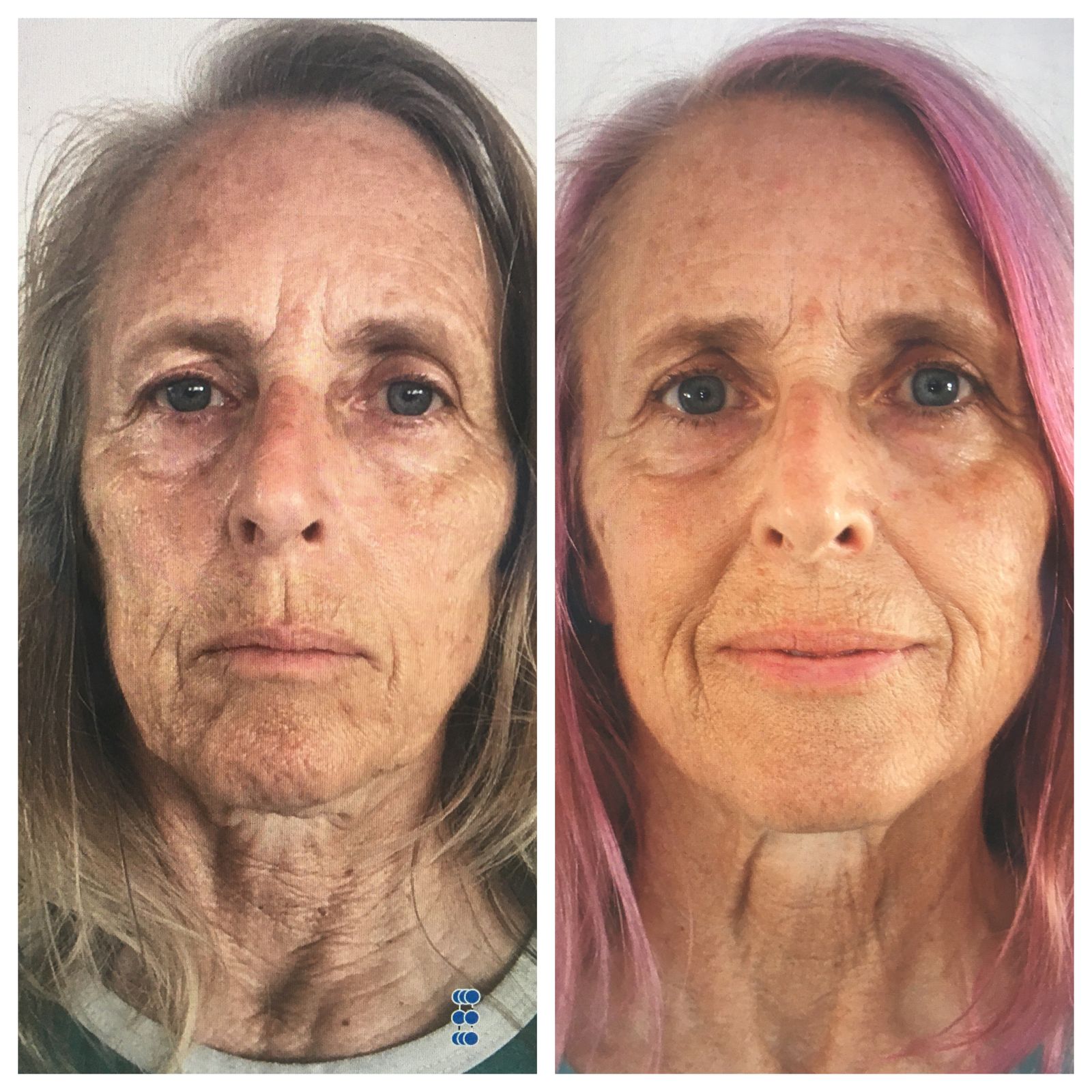 Before and after results from face yoga, botox alternative