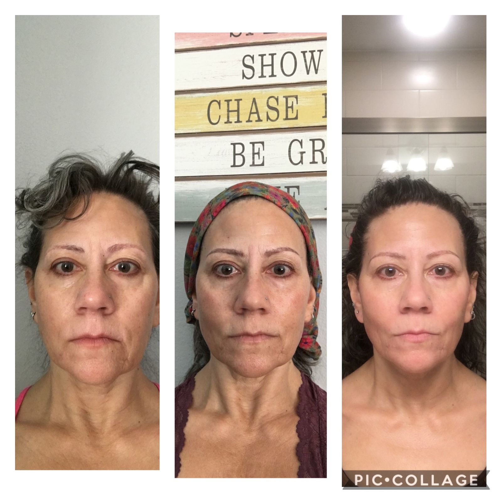 before and after results from face yoga, botox alternative