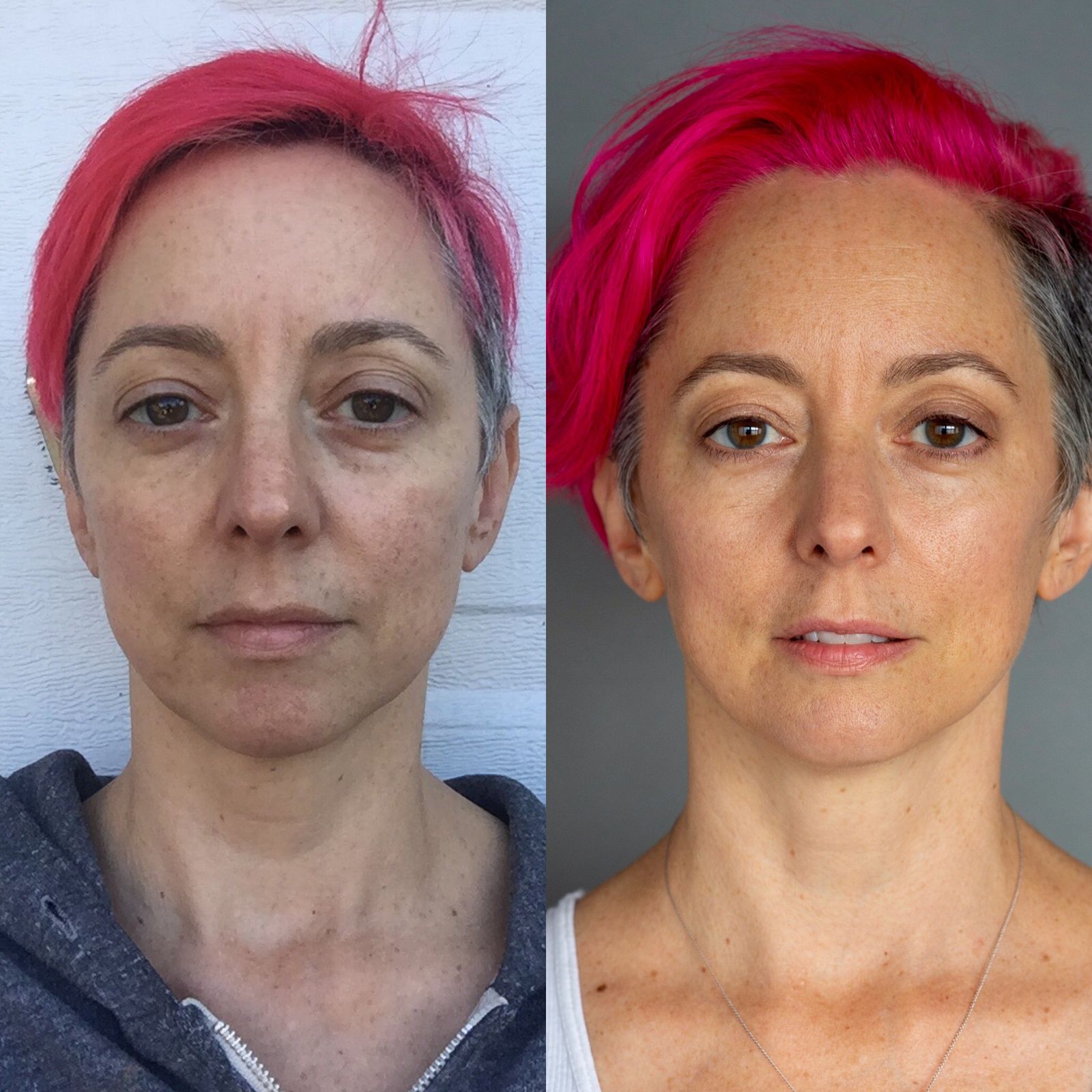 before and after face yoga, results, botox alternative
