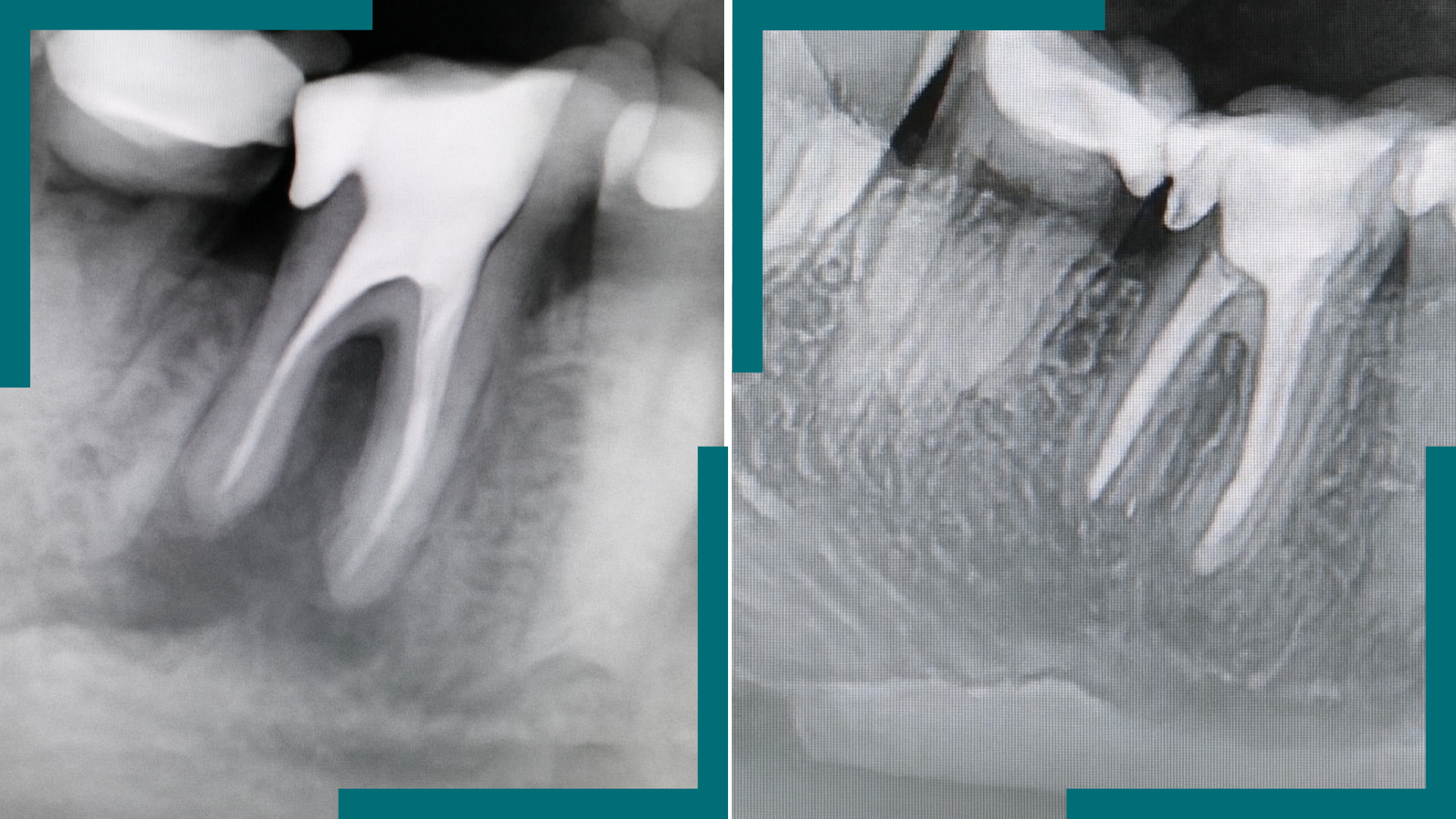 Dentisterie.9 : Endodontie
