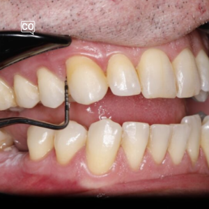 De detectie van pockets