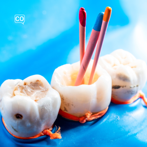 De gutta-percha-vulling