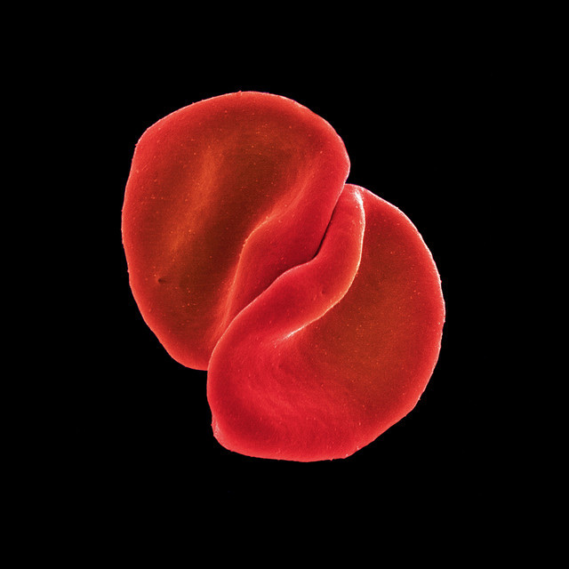 A close-up, microscopic view of two red blood cells. The cells are a vibrant red against a stark black background.
