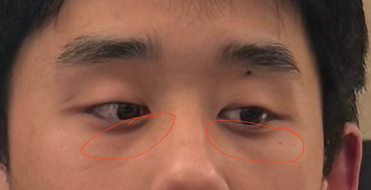 A close-up, cropped image focuses on the eyes and upper cheeks of an Asian man. Two orange circles highlight the under-eye areas, drawing attention to dark circles and the lacrimal groove.