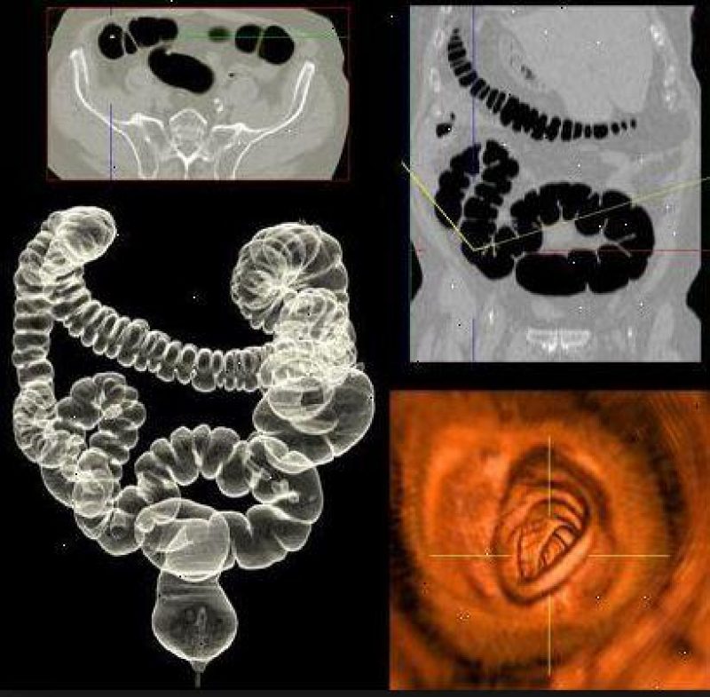 Можно сделать колоноскопию мрт. Кт-колонография (виртуальная колоноскопия). Кт - виртуальная колонография (виртуальная колоноскопия). Кт колонография кишечника. Кт колонография толстой кишки.