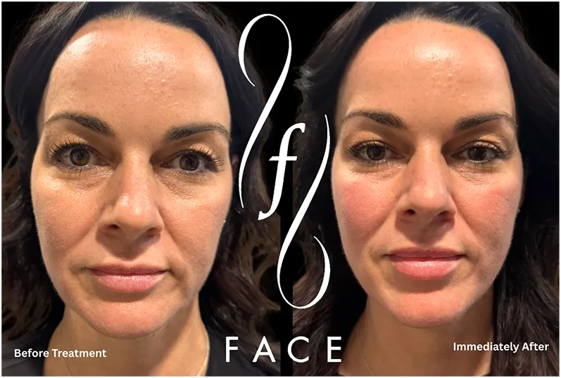 Discover Non-Invasive XERF Skin Tightening Options in Michigan