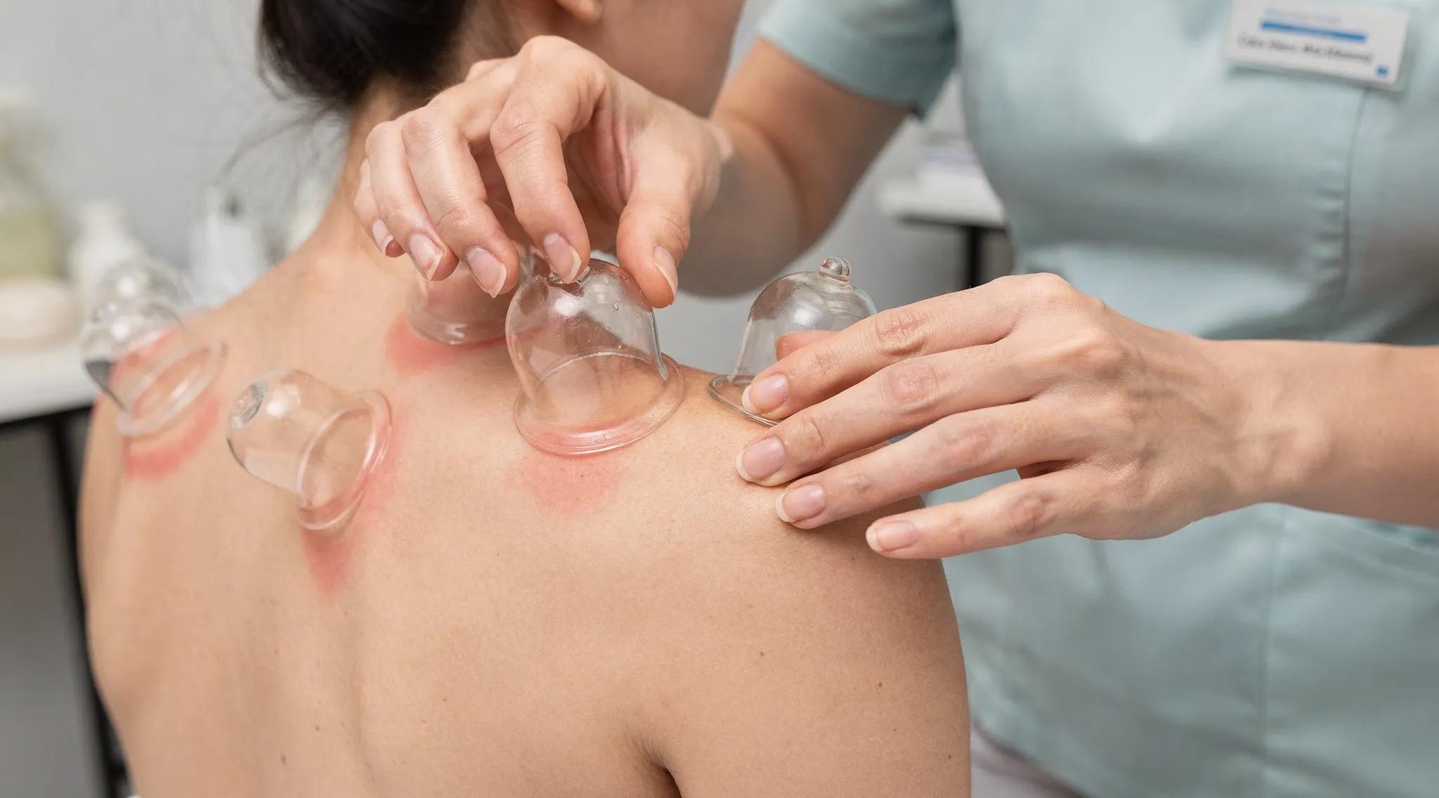 Therapist applying dry cupping technique on shoulder for pain relief and circulation