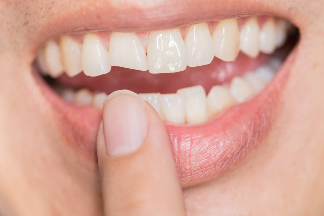 Expert Cracked Teeth Treatment in Dearborn, MI