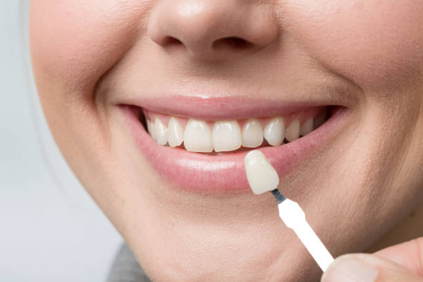 Transform Your Smile with Dental Veneers in Dearborn