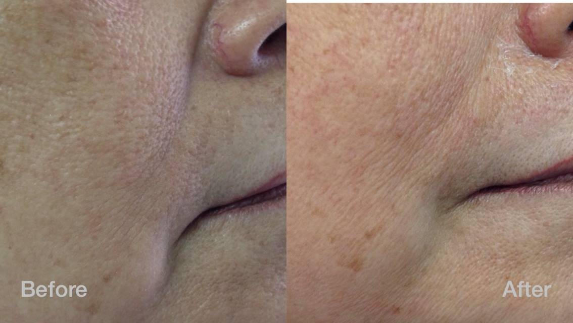 Explore Non-Invasive Laser Skin Rejuvenation