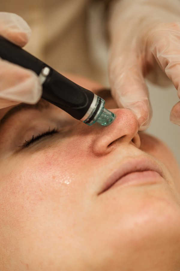 Hydrafacial in New Windsor
