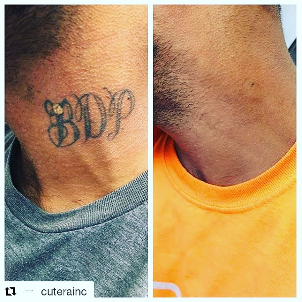Specialized Laser Tattoo Removal Solutions in Las Vegas