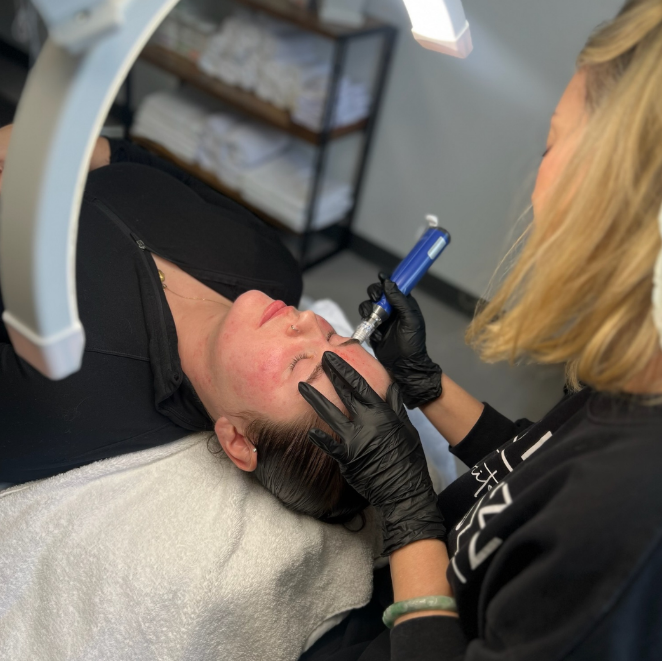 BBL Photofacial Enhancing Skin Obuvity