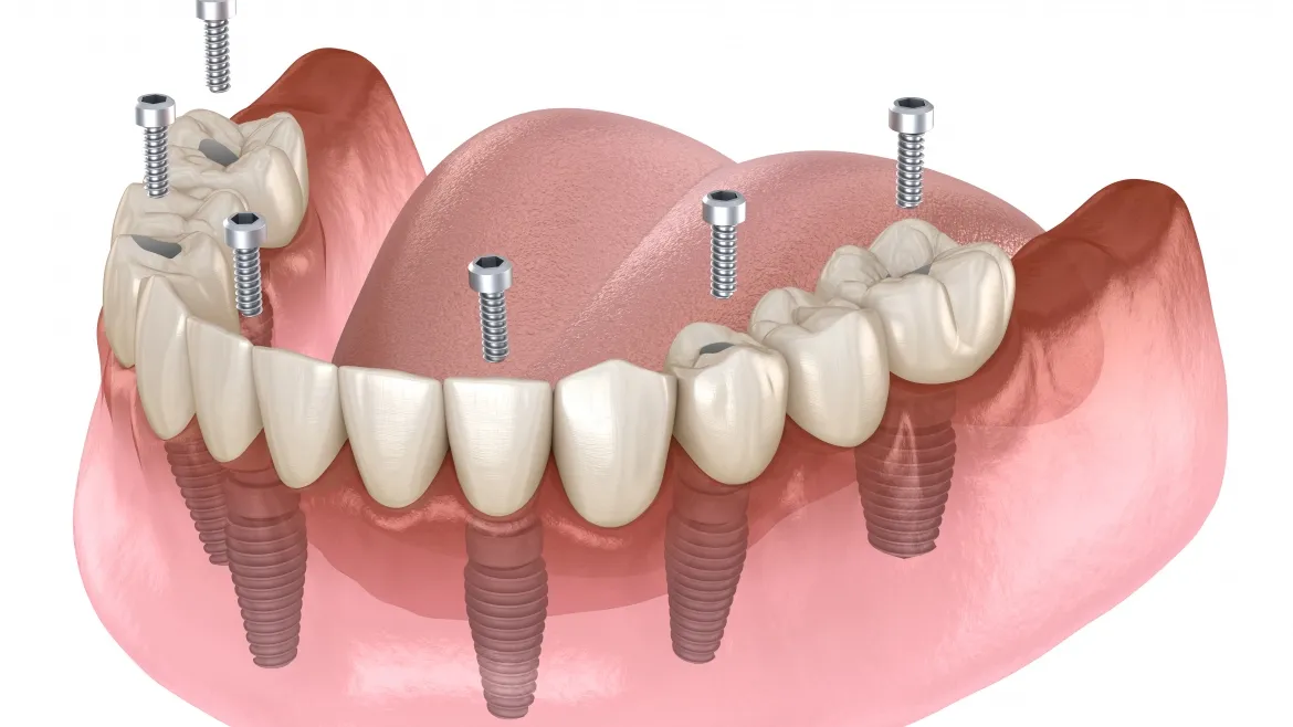 Leading Edge Dental Implants Services Sioux Falls