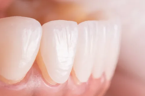 What Are Dental Veneers?