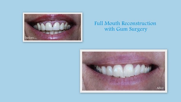 Reclaim Your Smile with Superior Dental Implant Solutions