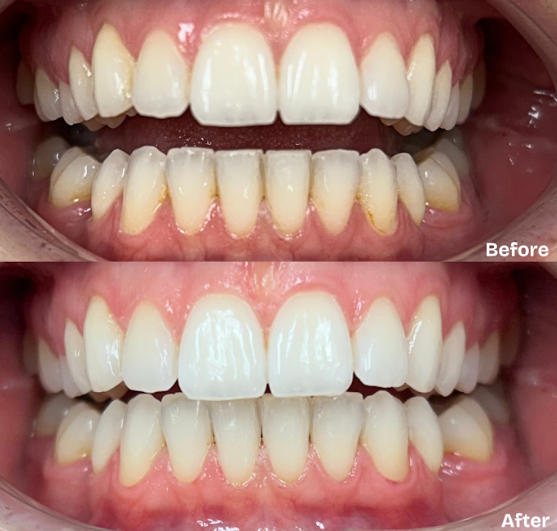 Biological Dental Cleaning & Plaque Sampling 