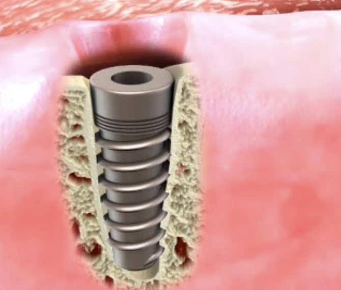 Discover Quality Dental Implants in Hastings, East Vancouver BC