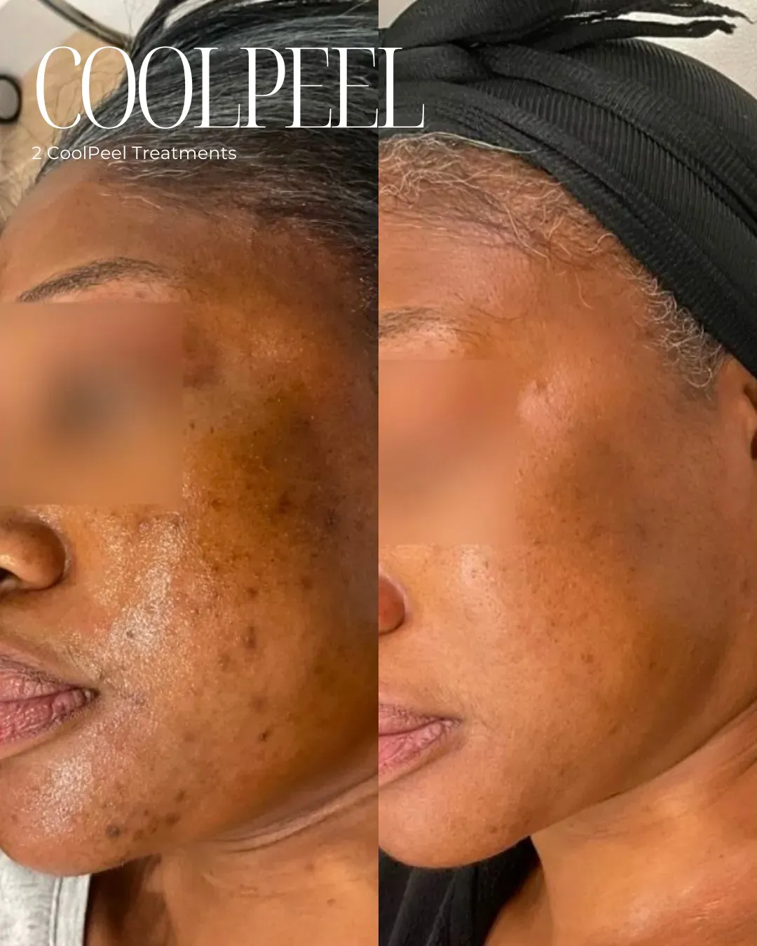 Injectables and Dermal Fillers
