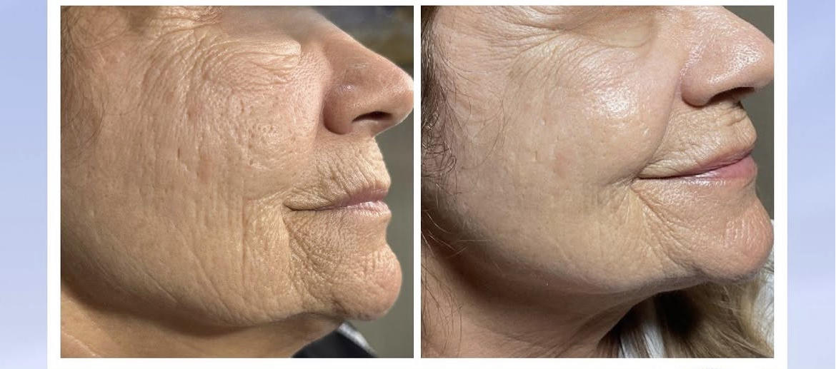 Comparison of facial skin before and after treatment, highlighting differences in texture and smoothness