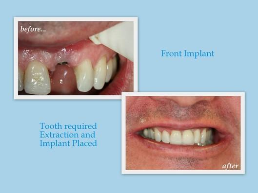 Advantages of Choosing Dental Implants