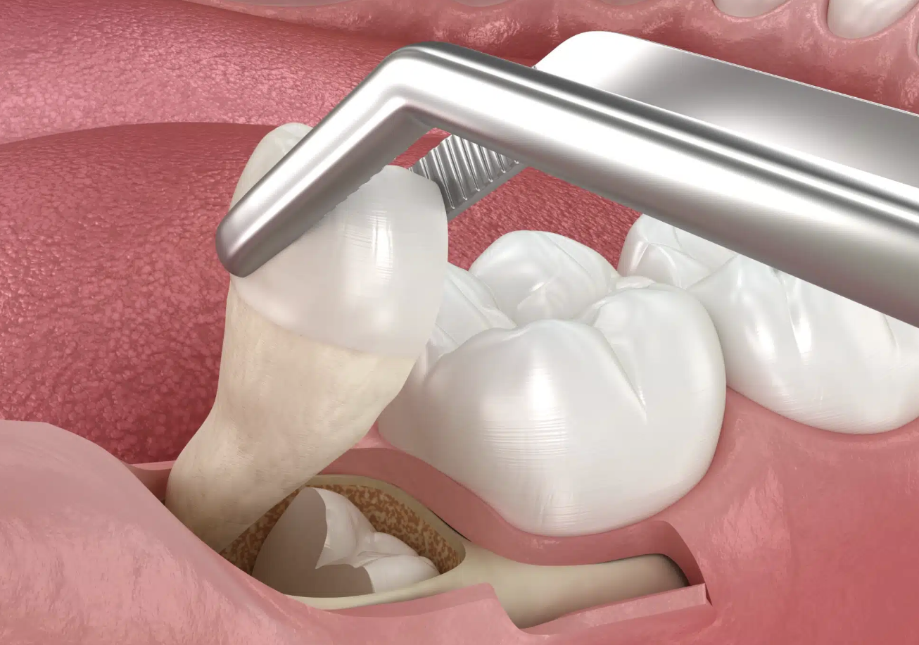 Understanding Wisdom Teeth Extraction