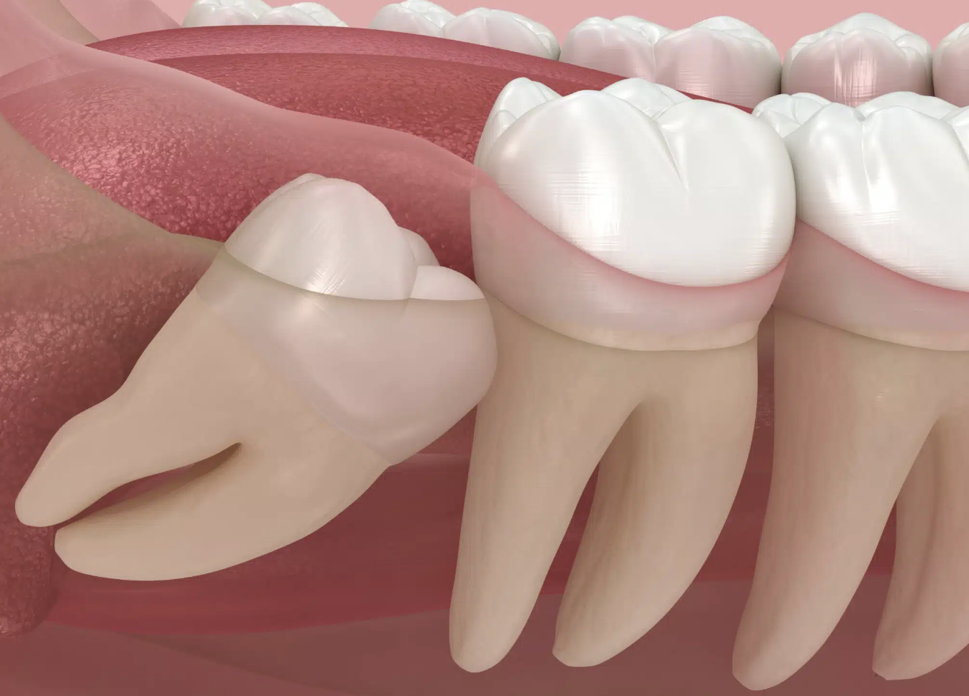 The Extraction Procedure Explained