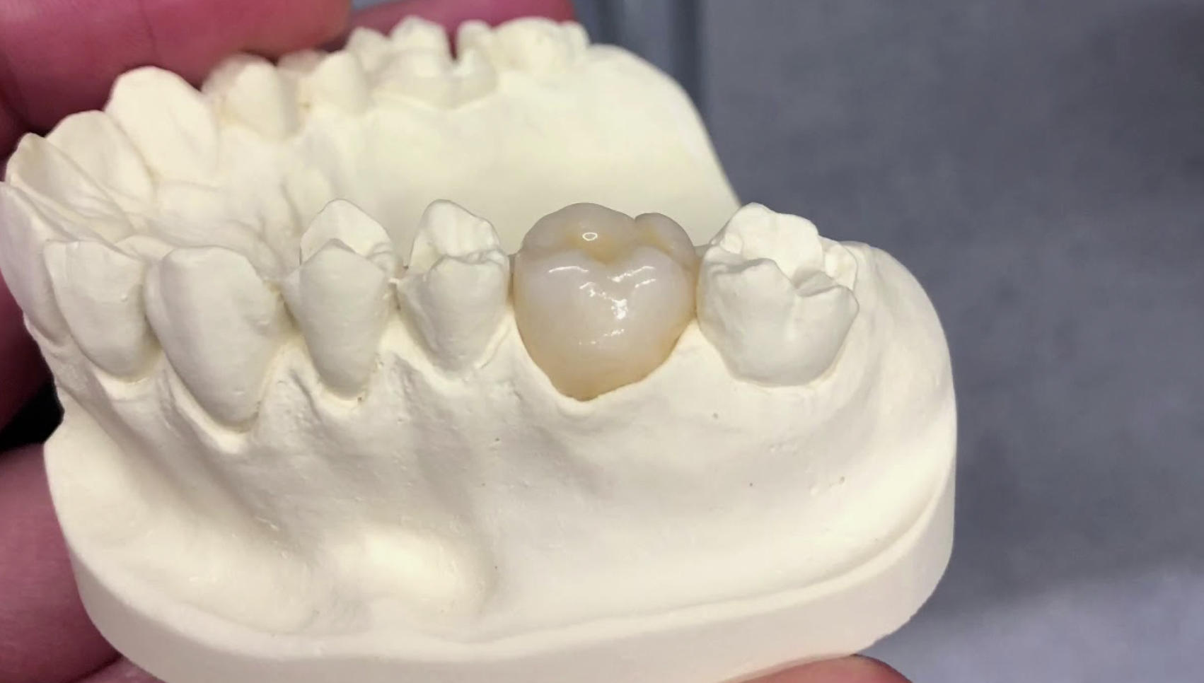 Reasons to Select A1 Care for CEREC Crowns