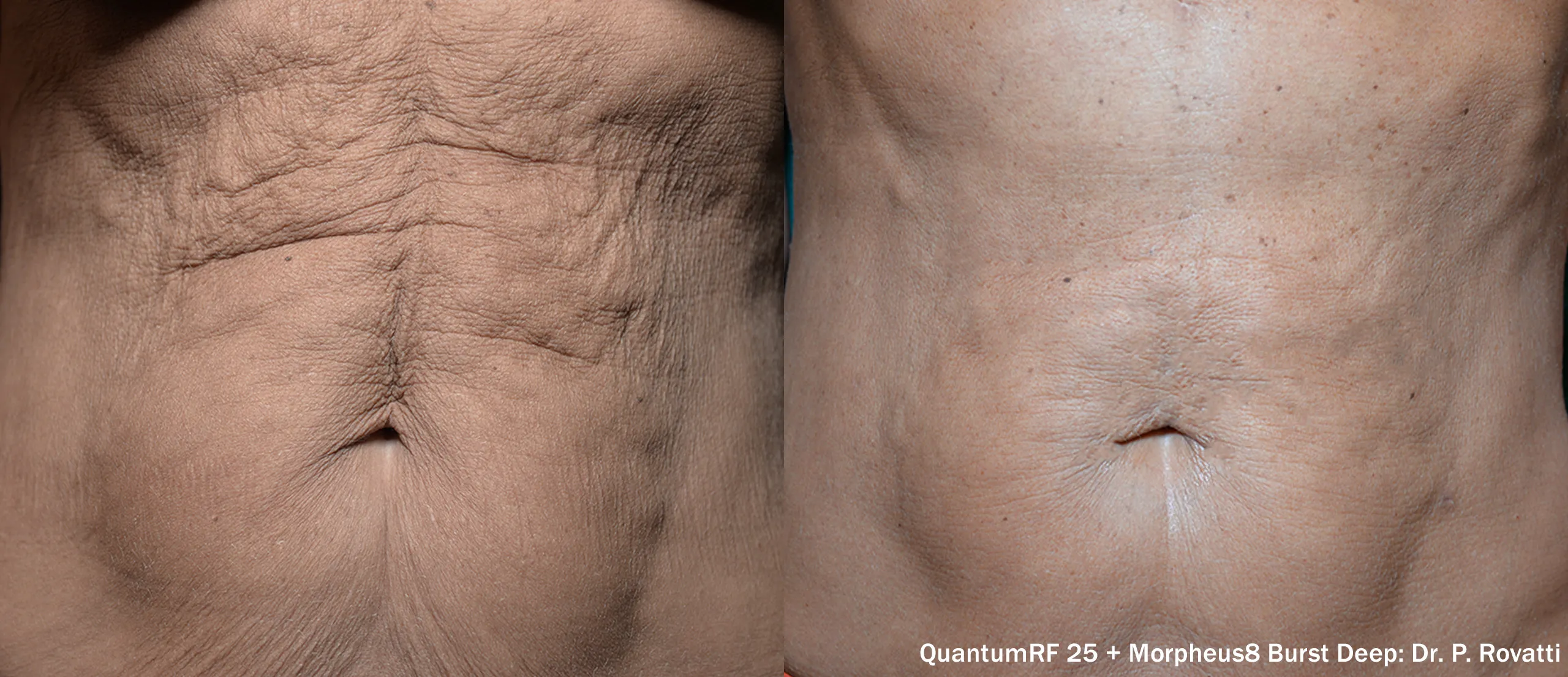 Before and after LUXORA treatment — abdomen tightening results