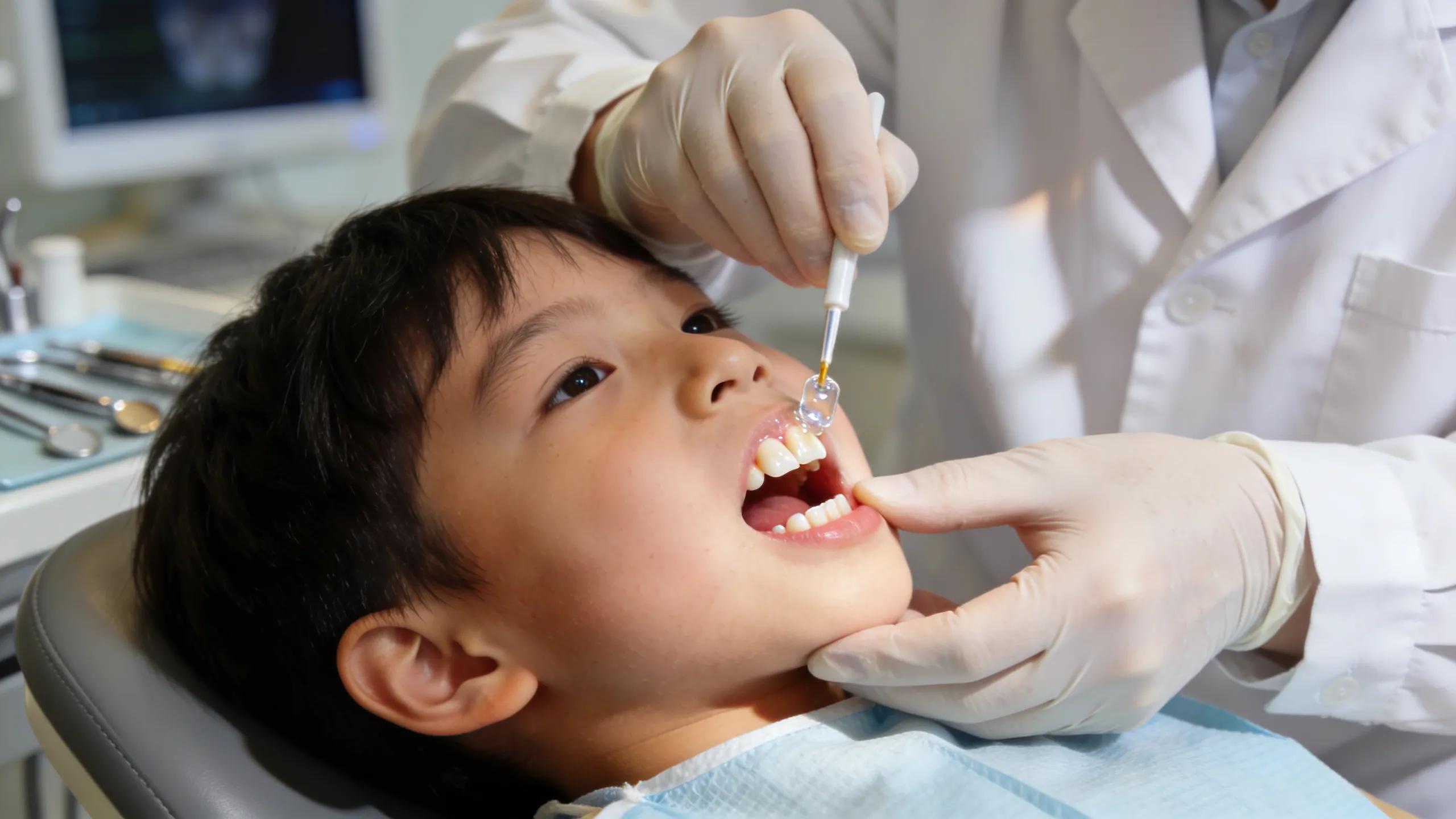 Dentist applying dental sealant on child's molar to prevent cavities