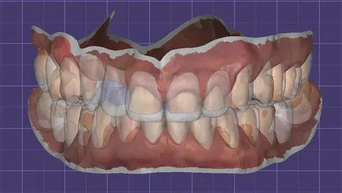 Advantages of Full Mouth Reconstruction