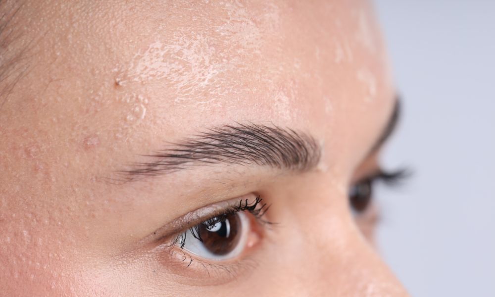 Close-up of flaky, peeling skin on a forehead, highlighting the need for restorative sensitive skincare products.