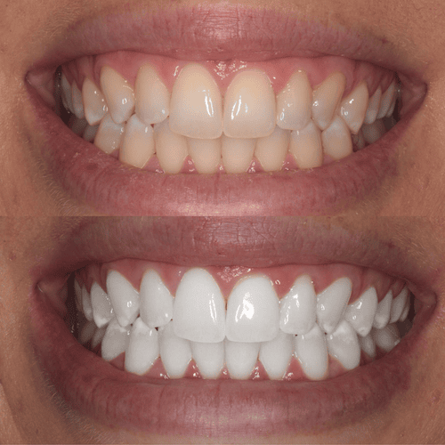 Expert Care for Impacted and Erupted Wisdom Teeth