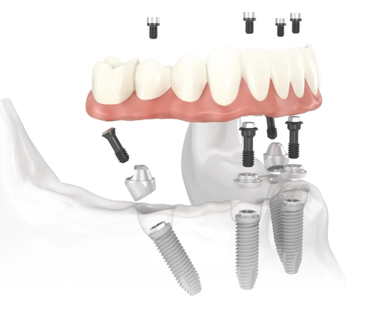 Understanding Detal Implants and Their Benefits