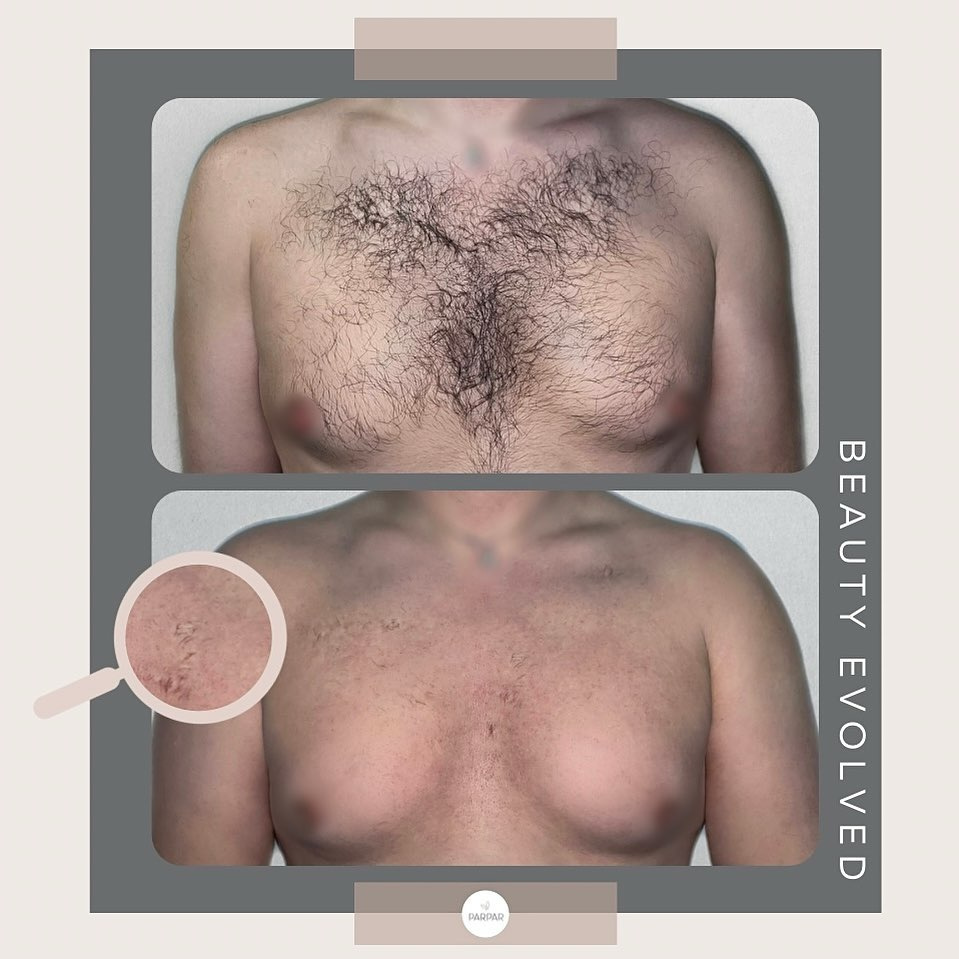 Discover Painless Laser Hair Removal in Suffern, NY